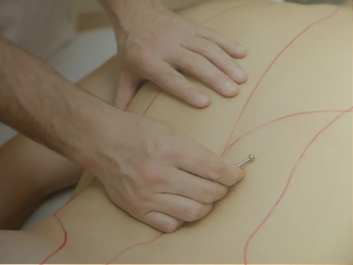 Akupunkt-Massage nach Penzel in Bretten